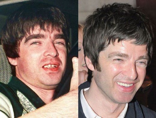Noel Gallagher Celebridades que tinham dentes ruins