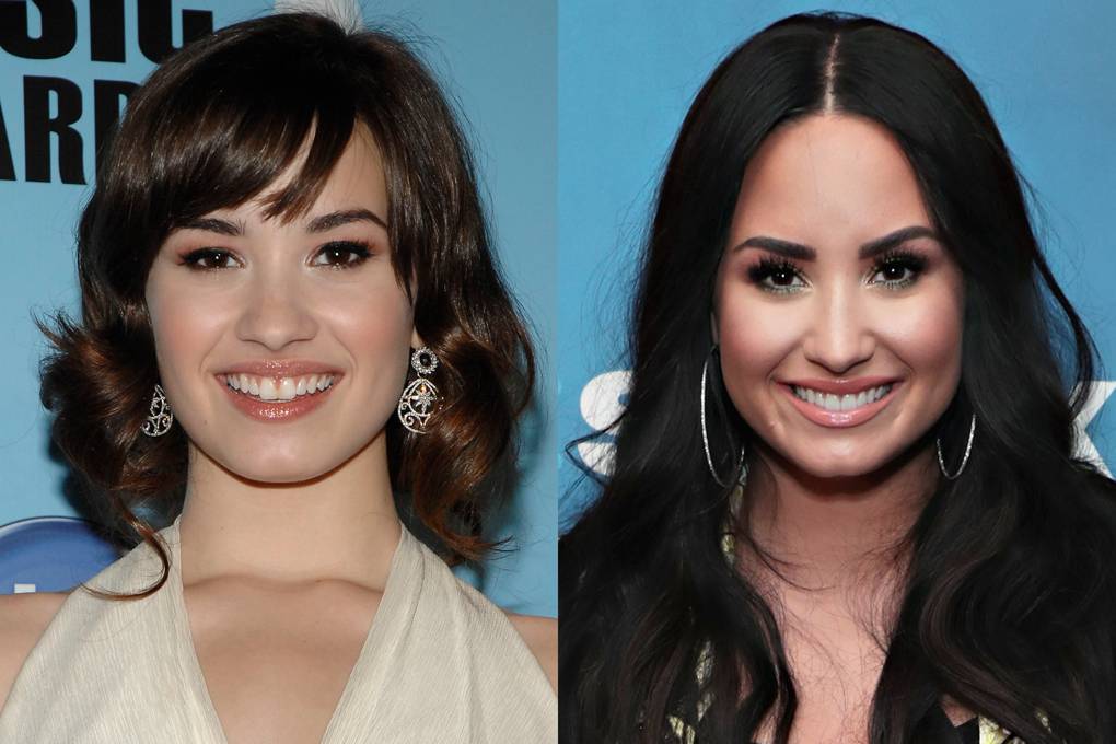 Demi Lovato As transformações mais dramáticas dos dentes de celebridades