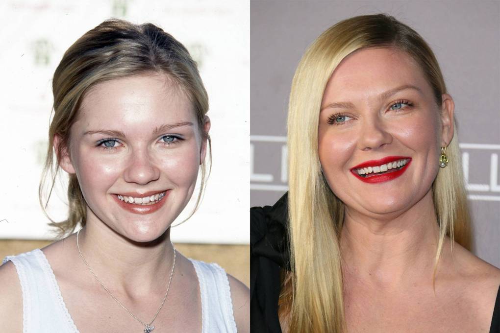 Kirsten Dunst As transformações mais dramáticas dos dentes de celebridades