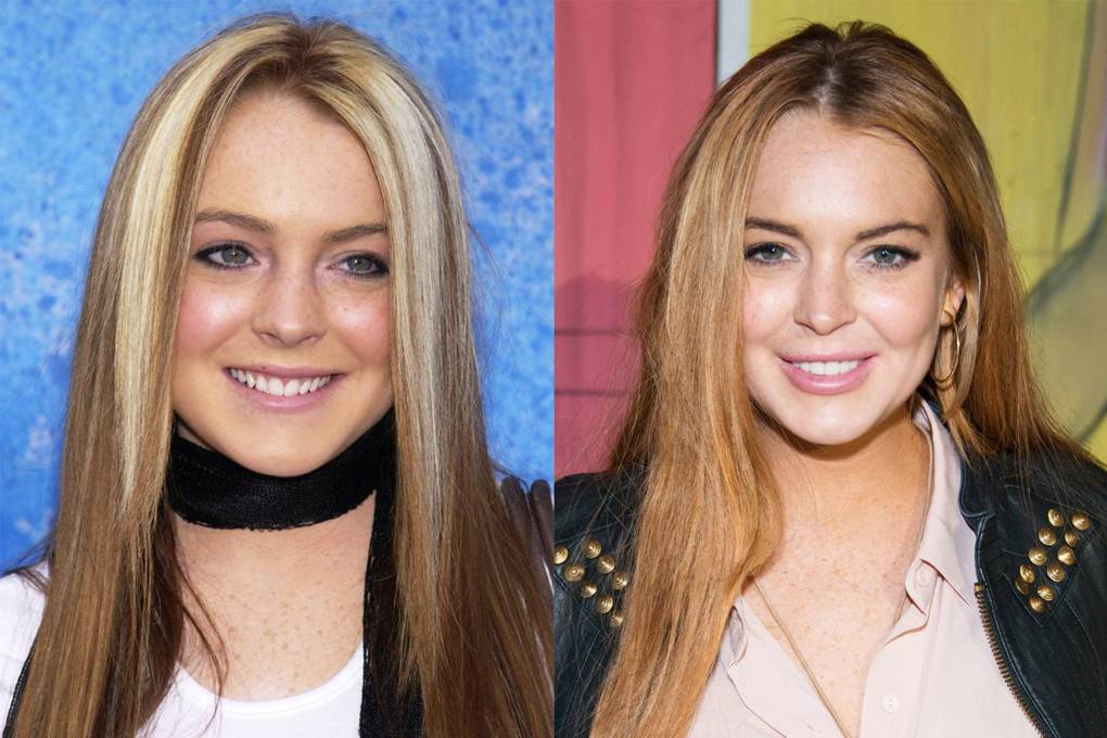 Lindsay Lohan As transformações mais dramáticas dos dentes de celebridades