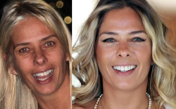 Adriane Galisteu e suas escolhas cirúrgicas: Mamoplastia de Aumento e Rinoplastia