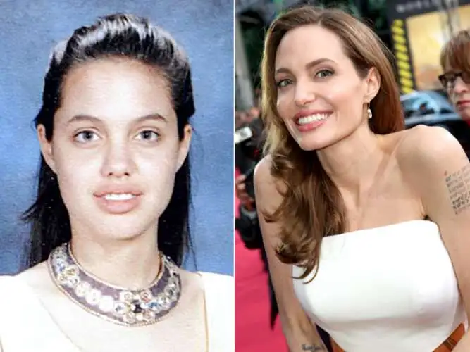 Angelina Jolie: mastectomia preventiva dupla