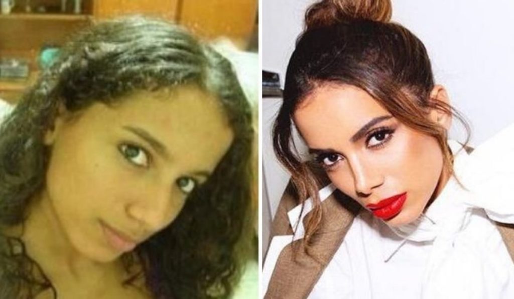 Anitta e suas intervenções estéticas: Rinoplastia e Lipoaspiração