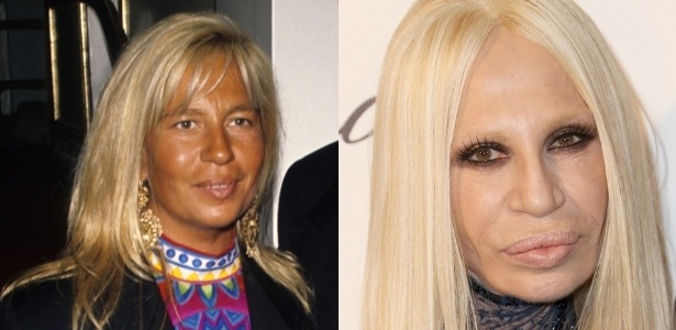 Donatella Versace: preenchimentos faciais, botox, rinoplastia, facelift