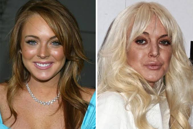 Lindsay Lohan: reconstrução estética, preenchimento labial, botox, rinoplastia