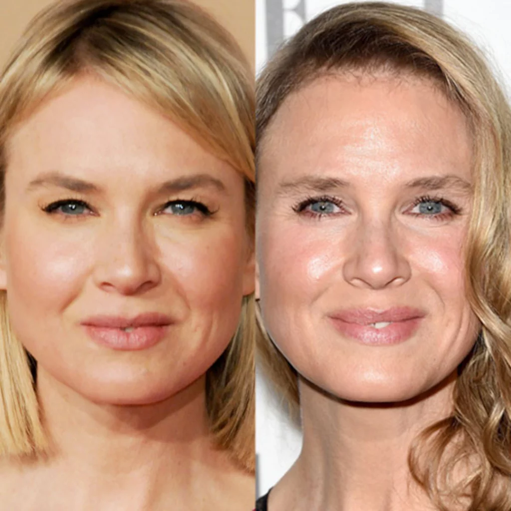 Renee Zellweger: rinoplastia, blefaroplastia, facelift