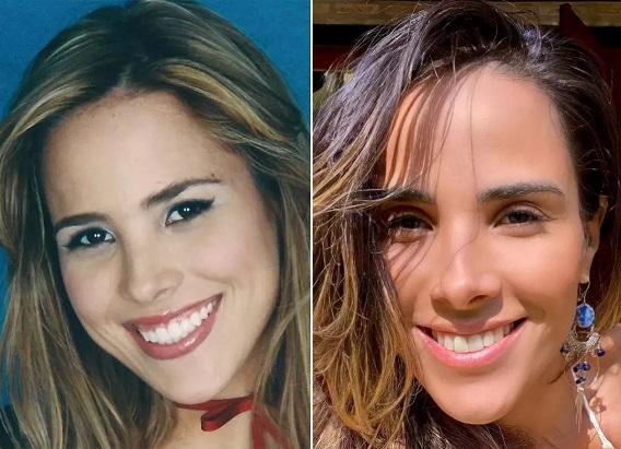 Wanessa Camargo e a harmonização facial: Rinoplastia Estética