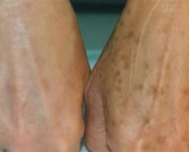 Você tem manchas de idade na sua pele? Com este truque simples elas podem desaparecer!