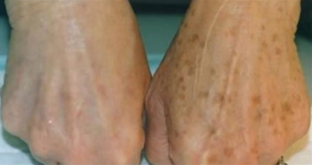 Descubra o segredo para eliminar as manchas de idade da sua pele com este método eficaz